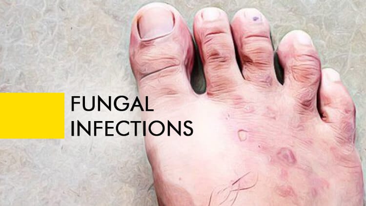 Fungal Infections - Natural Remedies For Men And Women 7 Fungal Infections Natural Remedies