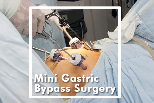 Mini Gastric Bypass Surgery: Revolutionizing Bariatric Surgery