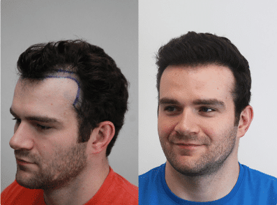 Difference Between Hairline & Hair Transplant Treatment