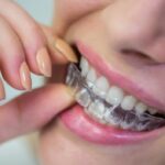 Everything You Need to Know About Using Invisalign as an Adult 26 About Using Invisalign as an Adult - Invisalign Treatment